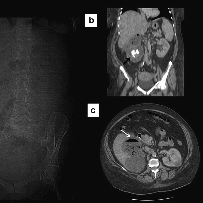 MRI Abdomen Plain