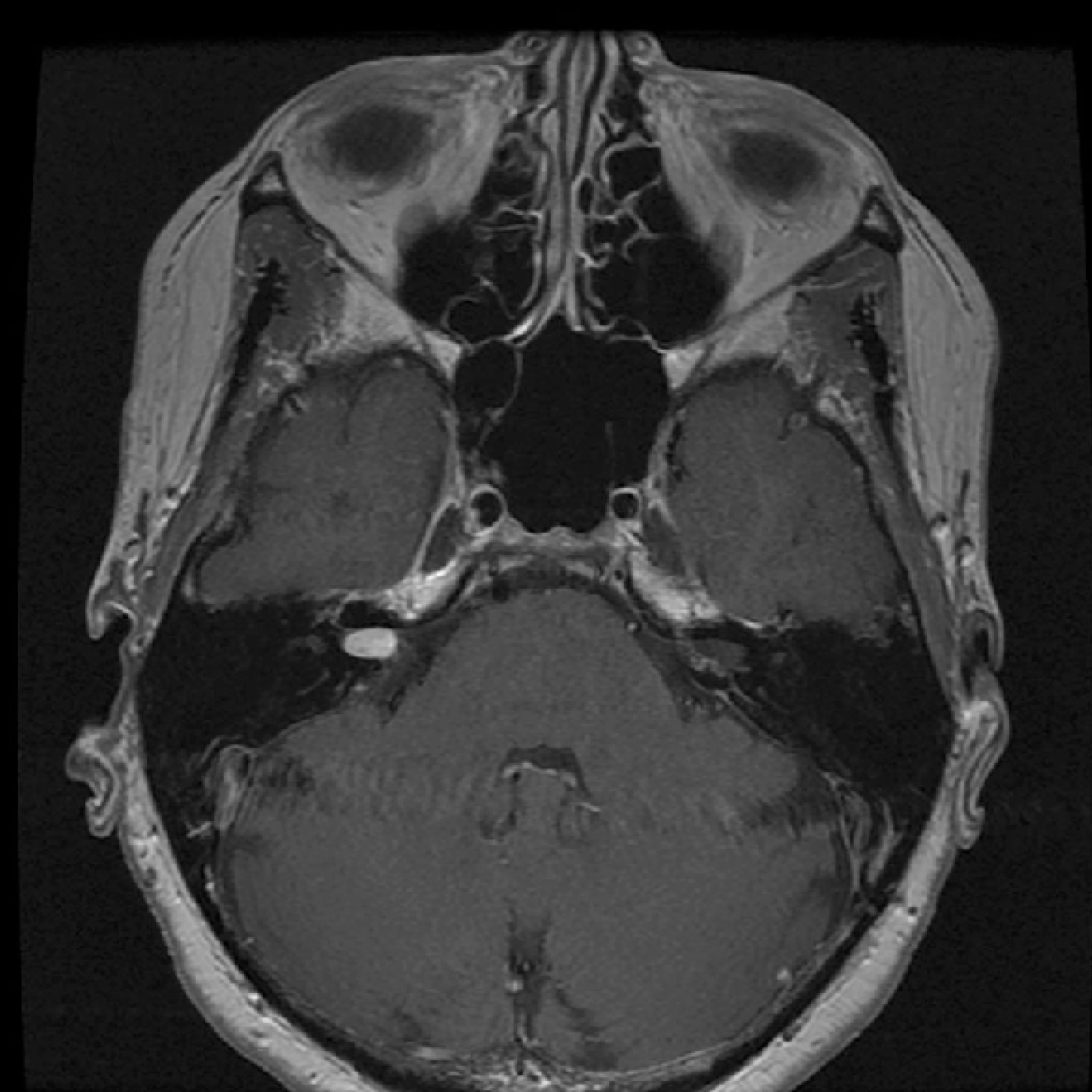 MRI Brain & Orbit with Contrast