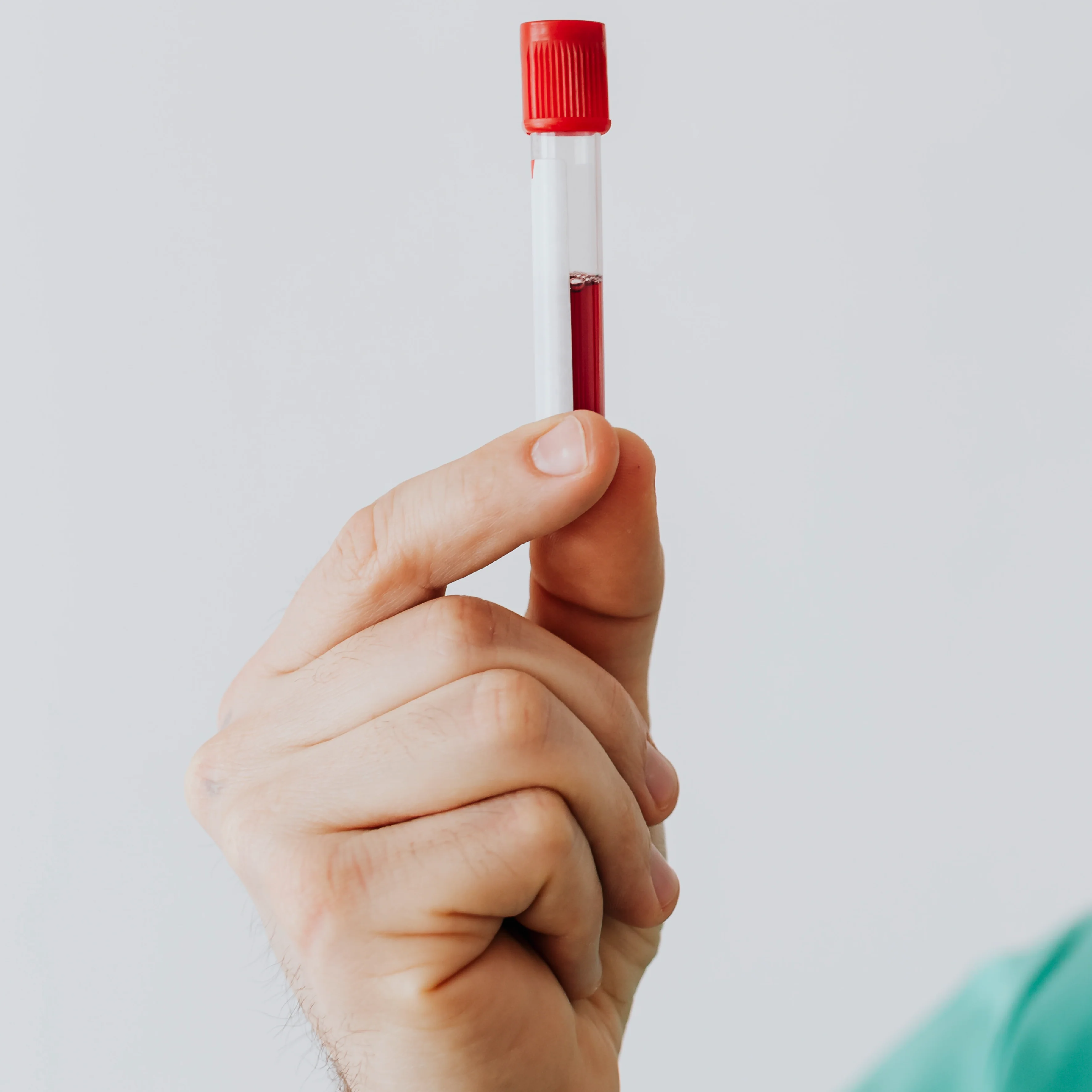 Perituneal Fluid for Amylase