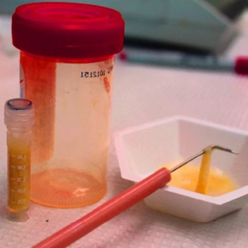Sputum AFB (ZNCF) - Fasting