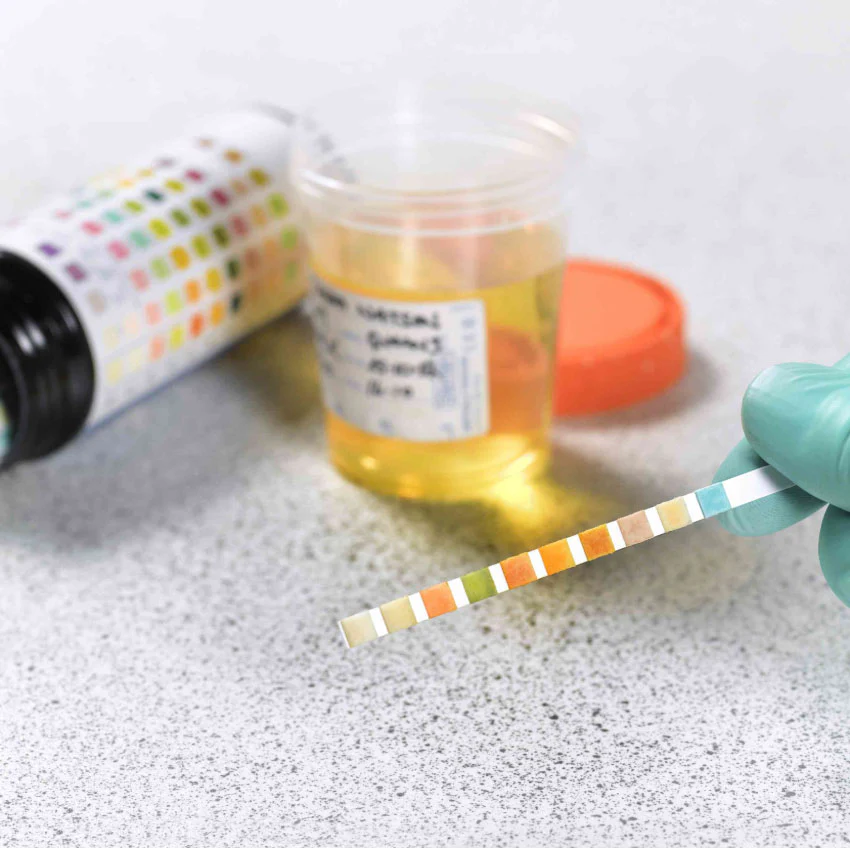 Urine Sugar